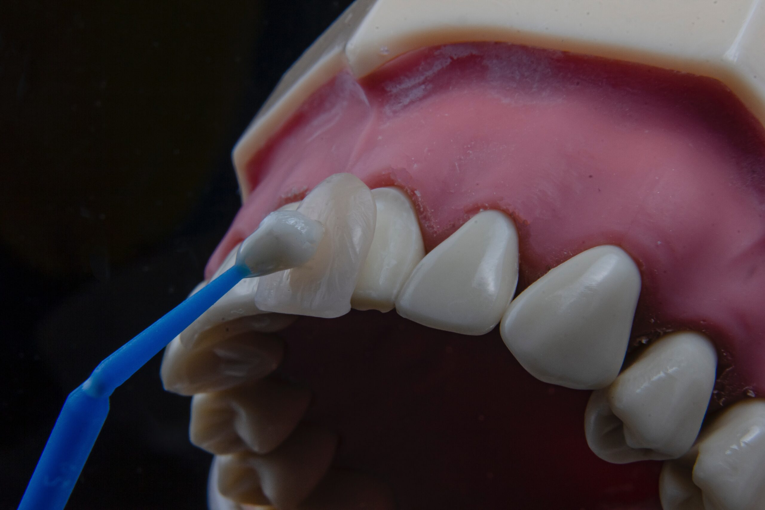 Fillings