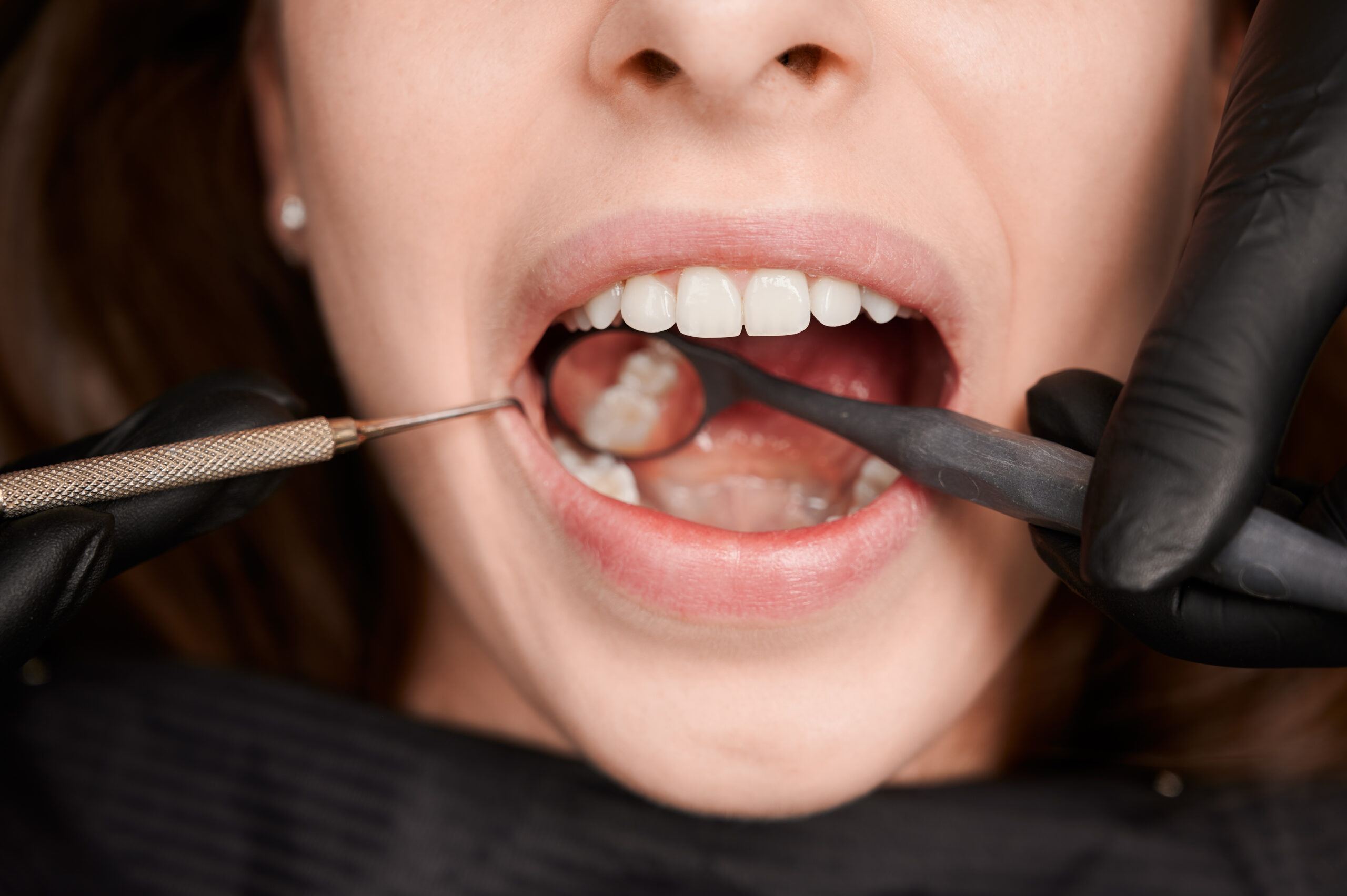 Teeth Whitening